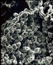 EM micrograph of lesion